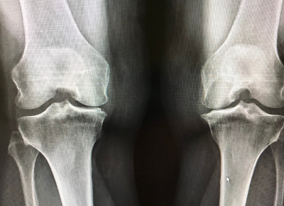 Osteoarthritis-